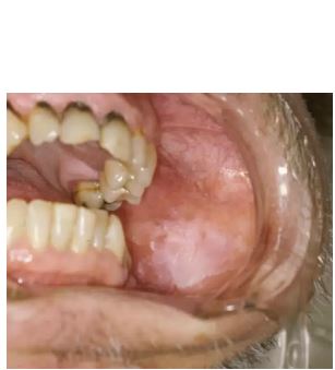 leukoplaakia