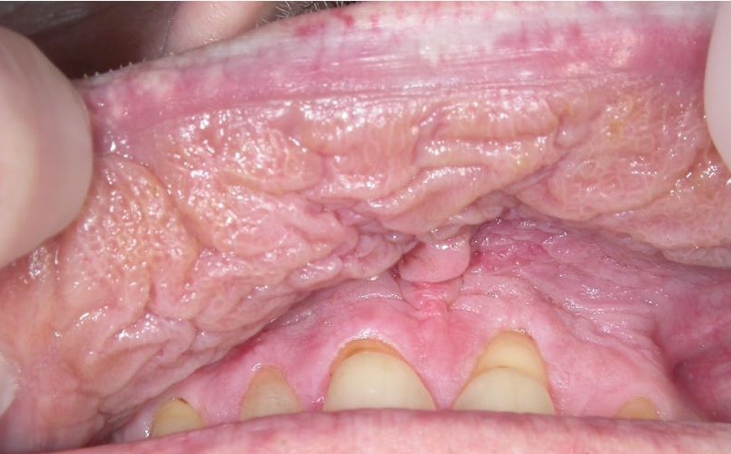 Närimistubakatarvitaja suulimaskest muutub paksemaks ja tekivad valged laigud, mis võivad olla kas