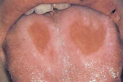 pilt