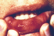 pilt