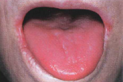 pilt