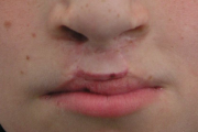 pilt